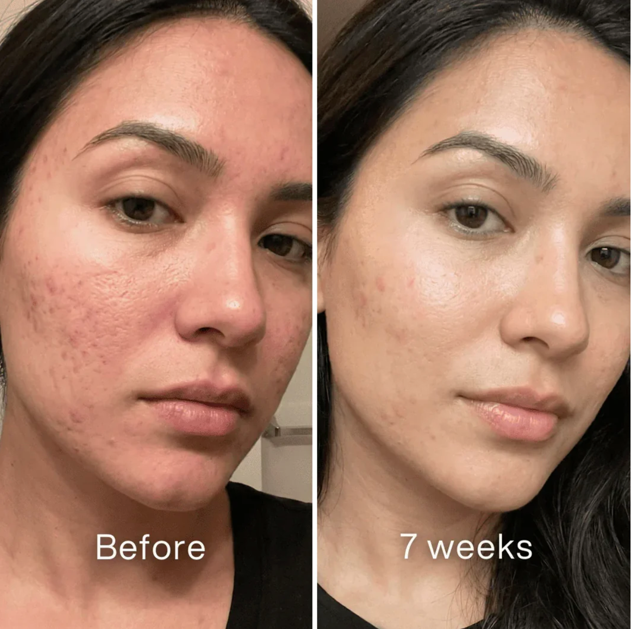 ScarSmooth: Clinical Acne Scar Silicone Stick