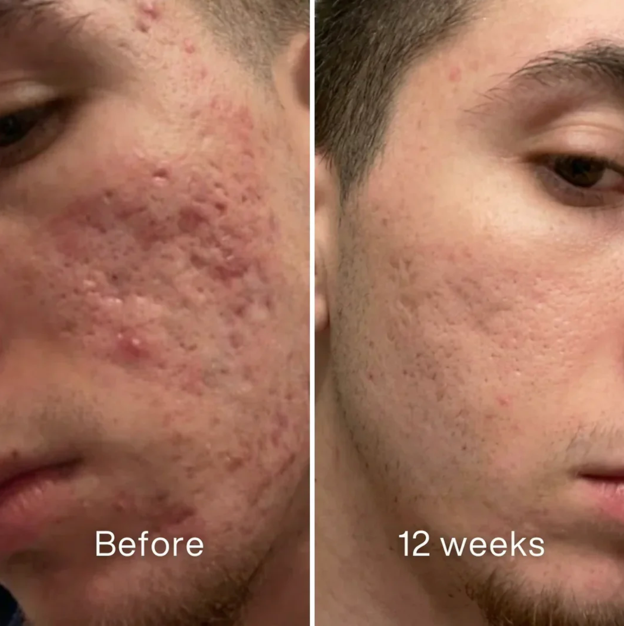 ScarSmooth: Clinical Acne Scar Silicone Stick