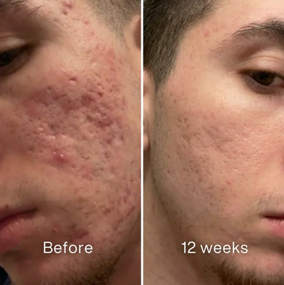ScarSmooth: Clinical Acne Scar Silicone Stick